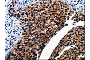 The image on the left is immunohistochemistry of paraffin-embedded Human renal cancer tissue using ABIN7189819(AP1B1 Antibody) at dilution 1/25, on the right is treated with synthetic peptide.