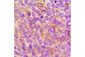 Immunohistochemical analysis of CD85c staining in human breast cancer formalin fixed paraffin embedded tissue section.
