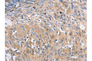 The image on the left is immunohistochemistry of paraffin-embedded Human cervical cancer tissue using ABIN7191576(NBEA Antibody) at dilution 1/60, on the right is treated with synthetic peptide. (Neurobeachin 抗体)