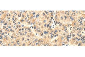 Immunohistochemistry of paraffin-embedded Human liver cancer tissue using TWIST2 Polyclonal Antibody at dilution 1:35 (TWIST2 抗体)