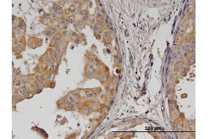 Immunoperoxidase of monoclonal antibody to ERBB2 on formalin-fixed paraffin-embedded human breast cancer. (ErbB2/Her2 抗体  (AA 22-121))