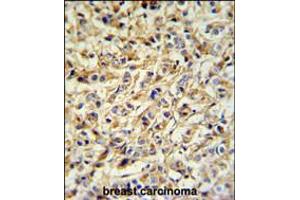 PRELP Antibody IHC analysis in formalin fixed and paraffin embedded breast carcinoma followed by peroxidase conjugation of the secondary antibody and DAB staining. (PRELP 抗体  (AA 119-148))