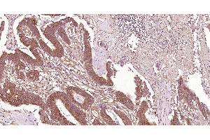 Paraformaldehyde-fixed, paraffin embedded Human colon cancer; Antigen retrieval by boiling in sodium citrate buffer (pH6.