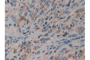 IHC-P analysis of Human Prostate cancer Tissue, with DAB staining. (DVL2 抗体  (AA 78-250))