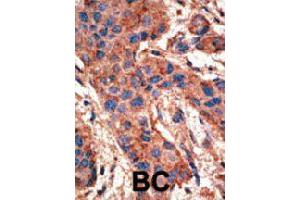 Formalin-fixed and paraffin-embedded human cancer tissue reacted with BMPR1A polyclonal antibody  , which was peroxidase-conjugated to the secondary antibody, followed by AEC staining. (BMPR1A 抗体  (AA 39-69))