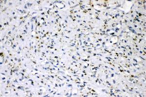 ADFP was detected in paraffin-embedded sections of human mammary cancer tissues using rabbit anti- ADFP Antigen Affinity purified polyclonal antibody (Catalog # ) at 1 µg/mL. (ADRP 抗体  (AA 226-418))