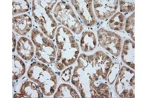 Immunohistochemical staining of paraffin-embedded Carcinoma of liver tissue using anti-RC203219 mouse monoclonal antibody. (ACSBG1 抗体)