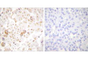 Peptide - +Immunohistochemical analysis of paraffin-embedded human breast carcinoma tissue using Cyclin F antibody (#C0168).