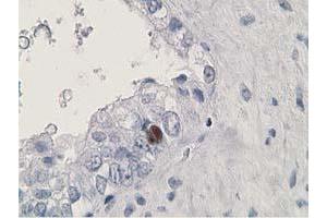 Immunohistochemical staining of paraffin-embedded Adenocarcinoma of Human ovary tissue using anti-HDHD2 mouse monoclonal antibody. (HDHD2 抗体)