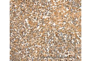 Immunohistochemistry of Human cervical cancer using SLC8A3 Polyclonal Antibody at dilution of 1:35 (SLC8A3 抗体)