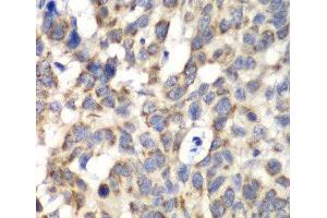 Immunohistochemistry of paraffin-embedded Human esophageal cancer using PARN Polyclonal Antibody at dilution of 1:100 (40x lens). (PARN 抗体)