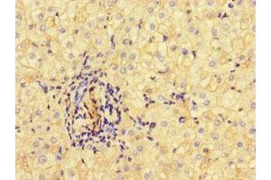 Immunohistochemistry of paraffin-embedded human liver cancer using ABIN7169360 at dilution of 1:100 (Albumin 抗体  (AA 76-389))