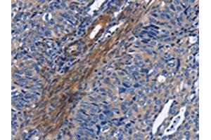 The image on the left is immunohistochemistry of paraffin-embedded Human cervical cancer tissue using ABIN7130344(NAT8 Antibody) at dilution 1/50, on the right is treated with fusion protein. (NAT8 抗体)