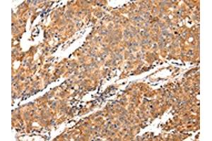 The image on the left is immunohistochemistry of paraffin-embedded Human prostate cancer tissue using ABIN7130145(MAP2 Antibody) at dilution 1/20, on the right is treated with fusion protein. (MAP2 抗体)