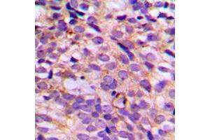 Immunohistochemical analysis of SGK223 (pY413) staining in human breast cancer formalin fixed paraffin embedded tissue section. (PRAGMIN 抗体  (pTyr413))