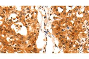 Immunohistochemistry of paraffin-embedded Human lung cancer using SERPINB5 Polyclonal Antibody at dilution of 1:60