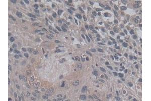 DAB staining on IHC-P; Samples: Human Lung cancer Tissue) (TGFB3 抗体  (AA 24-300))