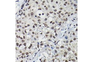 Immunohistochemistry of paraffin-embedded human breast cancer using Cyclin K Rabbit pAb (ABIN6128996, ABIN6138098, ABIN6138099 and ABIN6214445) at dilution of 1:100 (40x lens). (Cyclin K 抗体  (AA 1-160))