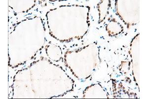 Immunohistochemical staining of paraffin-embedded Adenocarcinoma of Human colon tissue using anti-MTRF1L mouse monoclonal antibody. (MTRF1L 抗体)