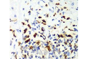 Immunohistochemistry of paraffin-embedded Human liver cancer using CAPG Polyclonal Antibody at dilution of 1:100 (40x lens). (CAPG 抗体)