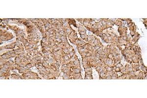 Immunohistochemistry of paraffin-embedded Human thyroid cancer tissue using AP1S1 Polyclonal Antibody at dilution of 1:65(x200) (AP1S1 抗体)