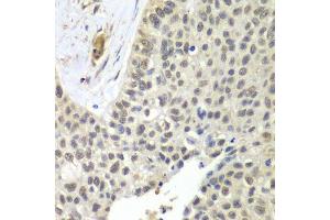 Immunohistochemistry of paraffin-embedded human lung cancer using SNRPD2 antibody. (SNRPD2 抗体  (AA 1-118))