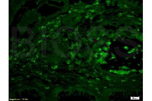 Formalin-fixed and paraffin embedded human colon carcinoma labeled Anti-IL-4R/CD124 Polyclonal Antibody, Unconjugated (ABIN740565) at 1:200 followed by conjugation to the secondary antibody Goat Anti-Rabbit IgG, AF488 conjugated used at 1:200 dilution (IL4 Receptor 抗体  (AA 201-300))