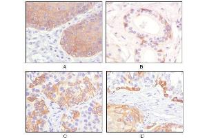 Immunohistochemical analysis of paraffin-embedded human esophagus epithelium (A), salivary gland basal cell (B), lung squamous cell carcinoma (C), endometrium admosquamous carcinoma (D), showing cytoplasmic and membrane localization using CK5 mouse mAb with DAB staining. (Cytokeratin 5 抗体)