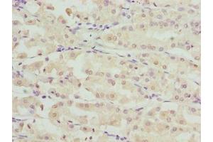 Immunohistochemistry of paraffin-embedded human gastric cancer using ABIN7168087 at dilution of 1:100 (RIBC2 抗体  (AA 1-309))