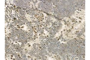 ABIN6258315 and ABIN6274373 at 1/100 staining human melanoma by IHC-P. (RHOH 抗体  (Internal Region))