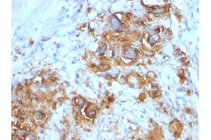 Formalin-fixed, paraffin-embedded human Gastric Carcinoma stained with CA19-9 Mouse Monoclonal Antibody (121SLE). (CA 19-9 抗体)