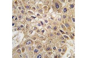 IHC analysis of FFPE human hepatocarcinoma tissue stained with AMFR antibody (AMFR 抗体  (AA 571-601))