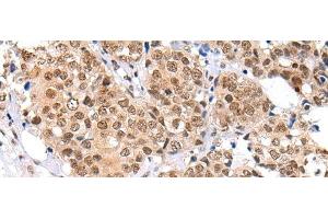 Immunohistochemistry of paraffin-embedded Human breast cancer tissue using KEAP1 Polyclonal Antibody at dilution of 1:35(x200)
