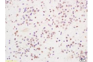 Formalin-fixed and paraffin embedded human glioma tissue labeled with Anti PIRH2 Polyclonal Antibody, Unconjugated (ABIN1386185) at 1:200 followed by conjugation to the secondary antibody and DAB staining (RCHY1 抗体  (AA 31-130))
