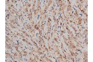 ABIN6269240 at 1/200 staining human breast cancer tissue sections by IHC-P. (STAT3 抗体  (C-Term))