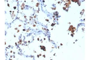 Formalin-fixed, paraffin-embedded human Lung Adenocarcinoma stained with Napsin A Mouse Monoclonal Antibody (NAPSA/3308). (NAPSA 抗体  (AA 189-299))