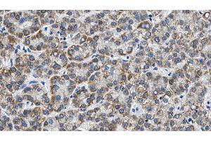 ABIN6268691 at 1/100 staining Human liver cancer tissue by IHC-P. (TJP1 抗体)