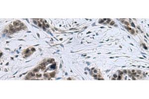 Immunohistochemistry of paraffin-embedded Human thyroid cancer tissue using CCAR2 Polyclonal Antibody at dilution of 1:40(x200) (CCAR2 抗体)