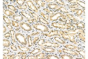 ABIN6261466 and ABIN6266885 at 1/100 staining Human kidney cancer and adjacent normal tissues by IHC-P. (EGR1 抗体  (Internal Region))