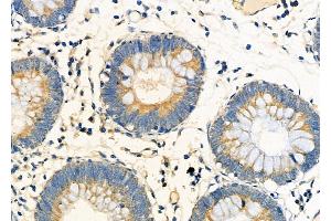 ABIN6261174 and ABIN6273223 at 1/100 staining Human colorectal cancer by IHC-P. (PPIC 抗体  (Internal Region))