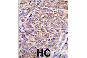 Formalin-fixed and paraffin-embedded human hepatocellular carcinoma reacted with TAOK3 polyclonal antibody  , which was peroxidase-conjugated to the secondary antibody, followed by DAB staining . (TAO Kinase 3 抗体  (C-Term))