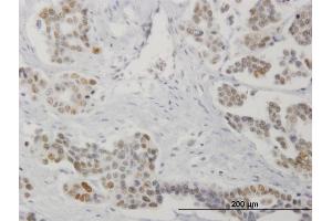 Immunoperoxidase of monoclonal antibody to STK17A on formalin-fixed paraffin-embedded human colon cancer. (STK17A 抗体  (AA 301-413))