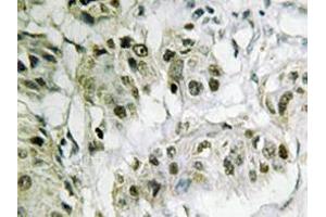 Immunohistochemistry analyzes of CtBP2 antibody in paraffin-embedded human breast carcinoma tissue. (CTBP2 抗体)
