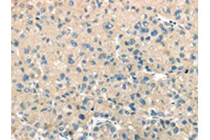 The image on the left is immunohistochemistry of paraffin-embedded Human liver cancer tissue using ABIN7131395(TMPRSS11A Antibody) at dilution 1/30, on the right is treated with fusion protein.