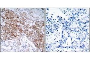 Immunohistochemistry analysis of paraffin-embedded human breast carcinoma tissue, using IGF1R (Ab-1161) Antibody. (IGF1R 抗体  (AA 1126-1175))