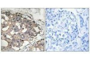 Immunohistochemistry analysis of paraffin-embedded human breast carcinoma tissue using B-RAF (Ab-446) antibody. (BRAF 抗体  (Ser446))