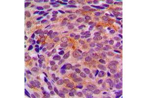 Immunohistochemical analysis of LYPLA1 staining in human breast cancer formalin fixed paraffin embedded tissue section. (LYPLA1 抗体  (Center))