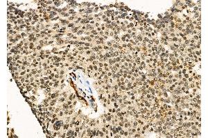 ABIN6266152 and ABIN6276644 at 1/100 staining Human ovarian cancer by IHC-P.