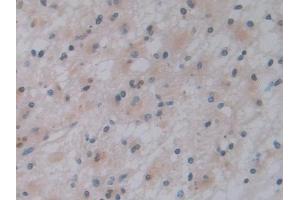 Detection of PTF1a in Human Glioma Tissue using Polyclonal Antibody to Pancreas Specific Transcription Factor 1a (PTF1a) (PTF1A 抗体  (AA 177-328))