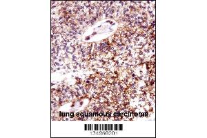 ECT2 Antibody immunohistochemistry analysis in formalin fixed and paraffin embedded human lung squamous carcinoma followed by peroxidase conjugation of the secondary antibody and DAB staining. (ECT2 抗体  (AA 597-625))
